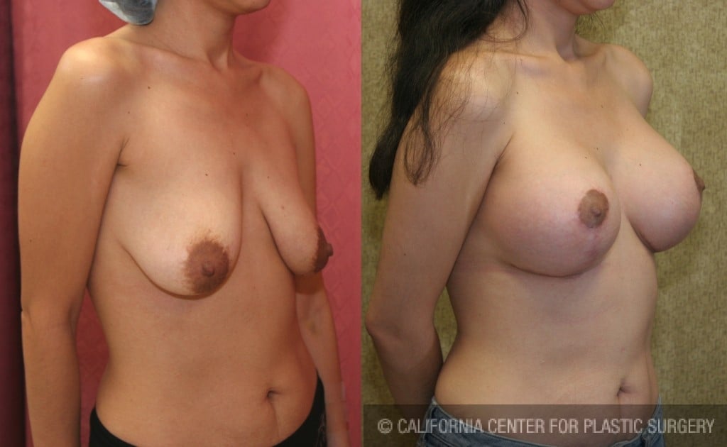 Breast Lift - Full Before & After Patient #6909
