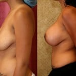 Breast Lift - Full Before & After Patient #6915