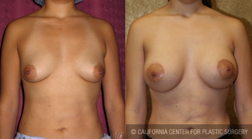 Breast Lift - Limited Before & After Patient #6582