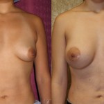 Breast Lift - Limited Before & After Patient #6582