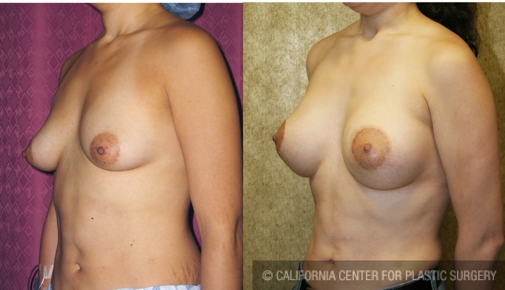 Breast Lift - Limited Before & After Patient #6582