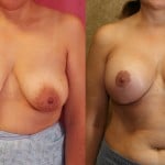 Breast Lift - Full Before & After Patient #6925