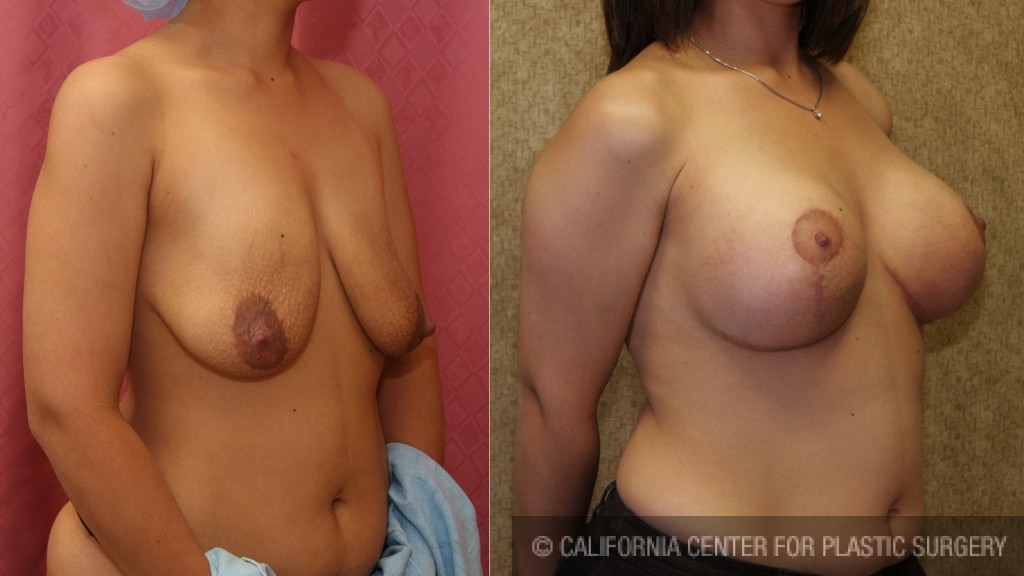 Breast Lift - Full Before & After Patient #6919