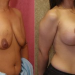 Breast Lift - Full Before & After Patient #6919