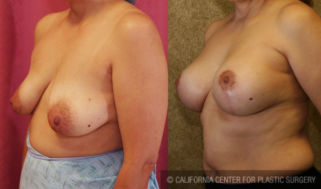 Breast Lift - Full Before & After Patient #6925