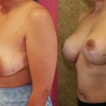 Breast Lift - Full Before & After Patient #6925