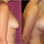 Breast Lift - Limited Before & After Patient #6582