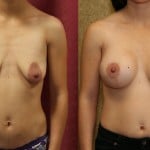 Breast Lift - Full Before & After Patient #6930