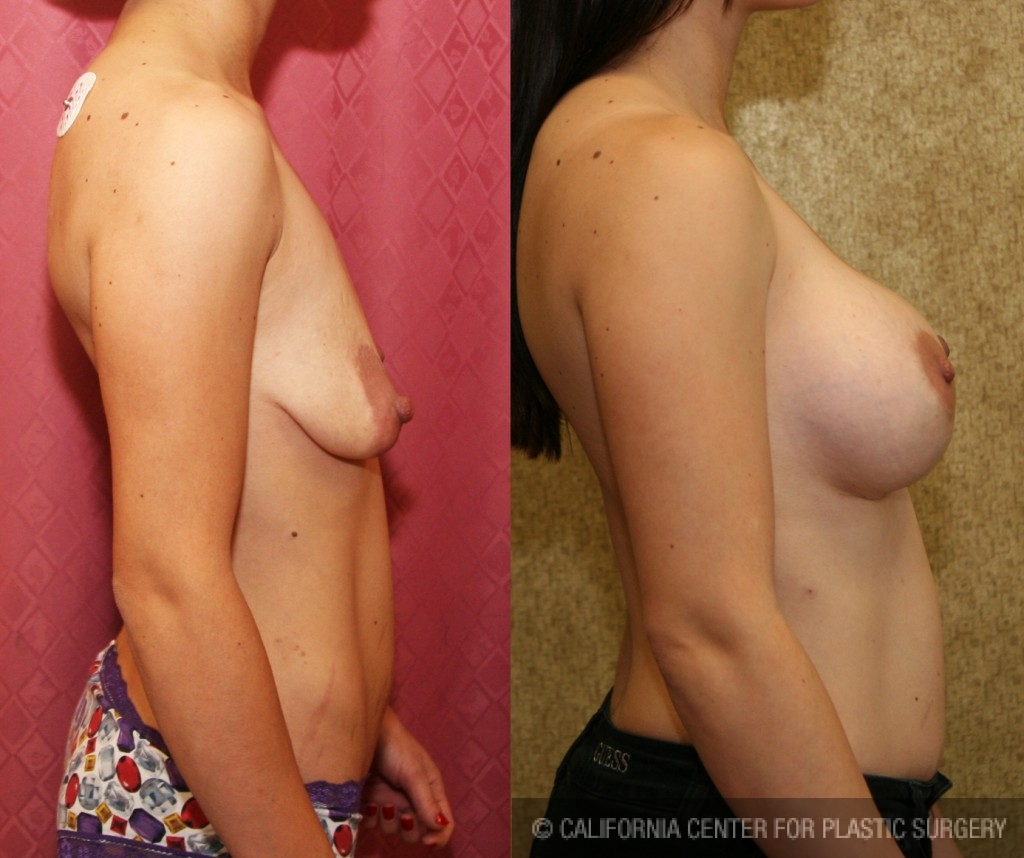 Breast Lift - Full Before & After Patient #6930