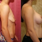 Breast Lift - Full Before & After Patient #6930