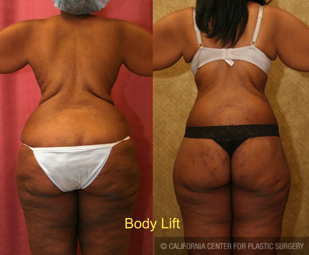 Body Lift Before & After Patient #6058