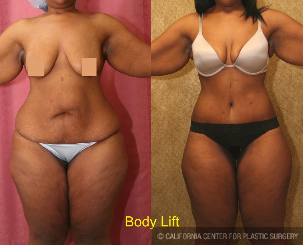 Body Lift Before & After Patient #6058