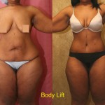 Body Lift Before & After Patient #6058