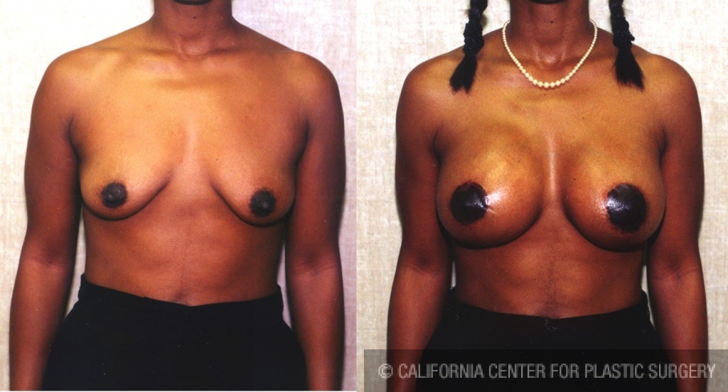 Breast Lift - Moderate Before & After Patient #6626
