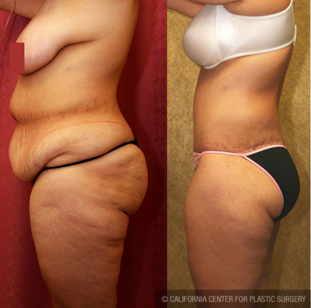 Body Lift Before & After Patient #6036