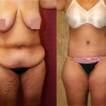 Body Lift Before & After Patient #6036