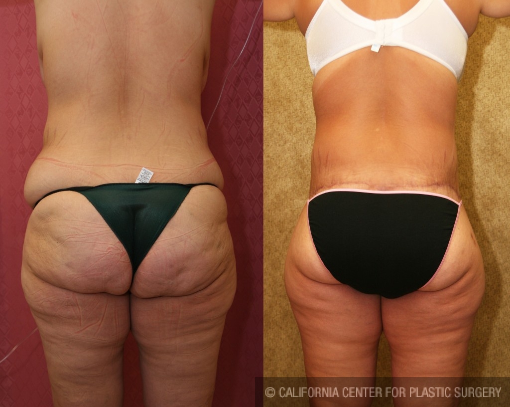Body Lift Before & After Patient #6036