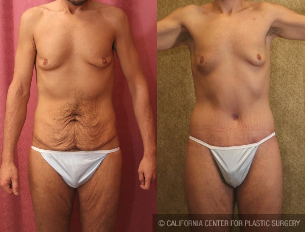 Body Lift Before & After Patient #6061