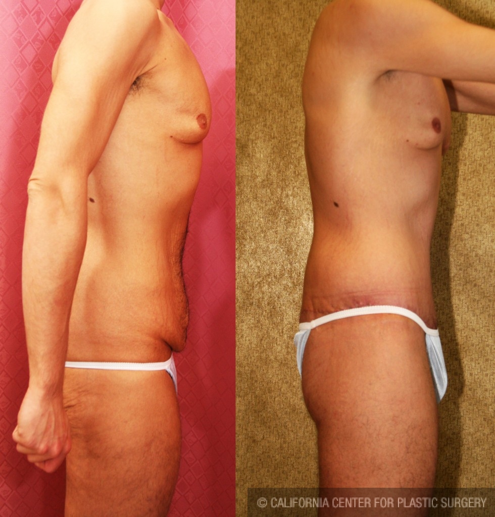 Body Lift Before & After Patient #6061
