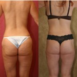 Body Lift Before & After Patient #6051