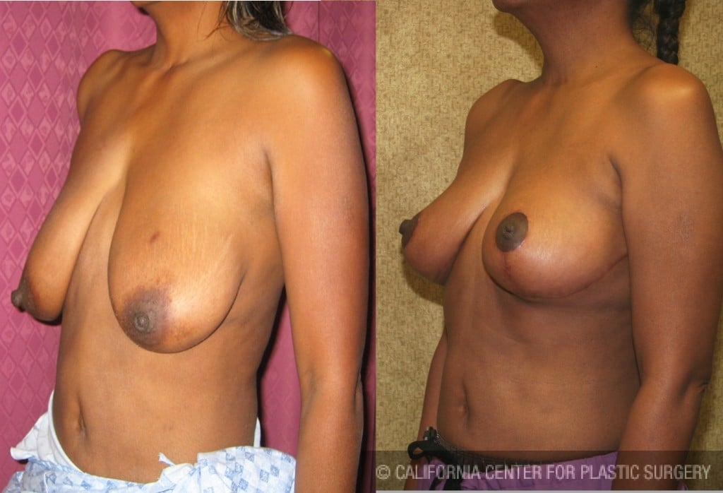 Breast Lift (Mastopexy) Before & After Patient #6692