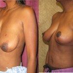 Breast Lift (Mastopexy) Before & After Patient #6692