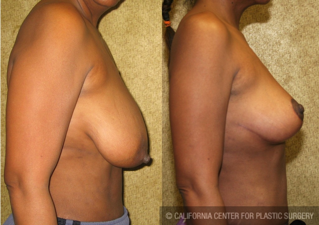 Breast Lift (Mastopexy) Before & After Patient #6692