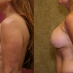 Breast Lift - Limited Before & After Patient #6593