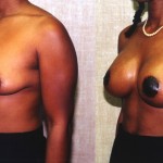 Breast Lift - Moderate Before & After Patient #6626