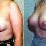 Breast Lift - Moderate Before & After Patient #6638