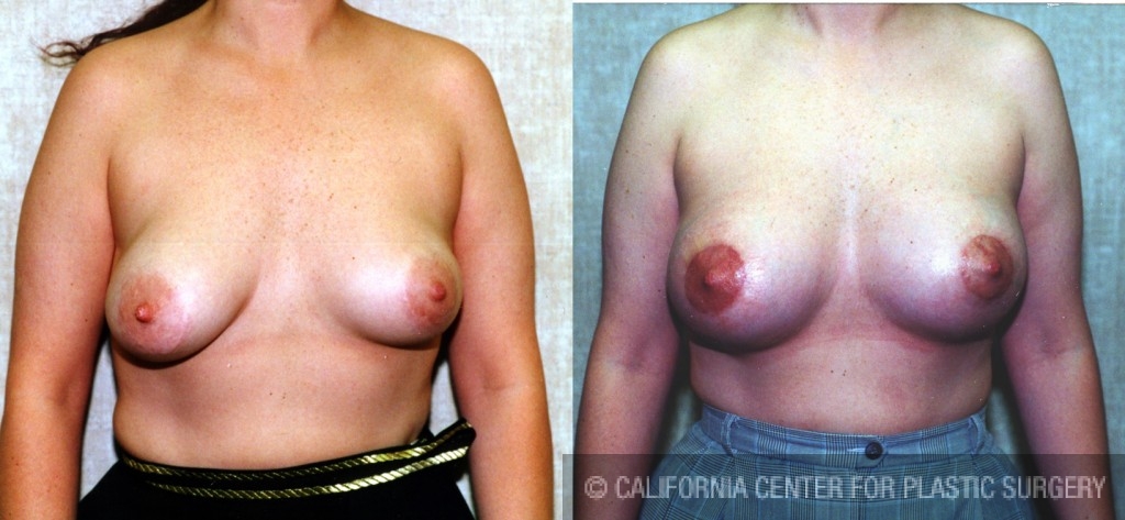 Breast Lift - Moderate Before & After Patient #6638