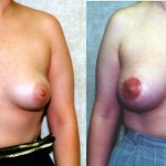 Breast Lift - Moderate Before & After Patient #6638