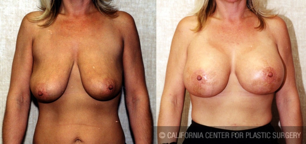 Breast Lift - Full Before & After Patient #6678