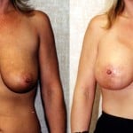Breast Lift - Full Before & After Patient #6678