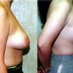 Breast Lift - Moderate Before & After Patient #6638