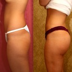 Buttock Lift/Augmentation Before & After Patient #6104