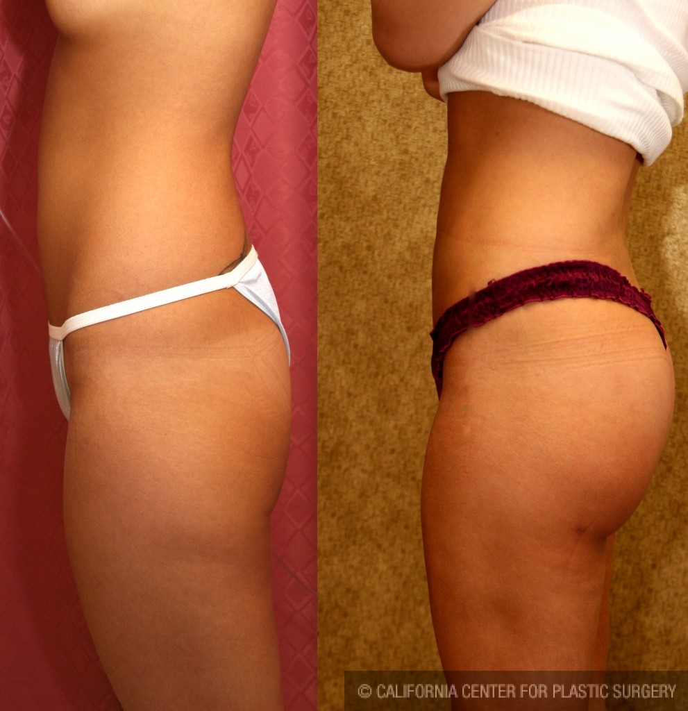 Buttock Lift/Augmentation Before & After Patient #6104