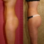 Buttock Lift/Augmentation Before & After Patient #6085