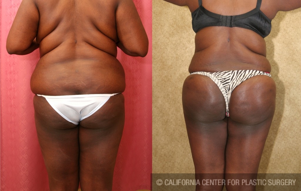 Buttock Lift/Augmentation Before & After Patient #6131