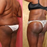 Buttock Lift/Augmentation Before & After Patient #6131