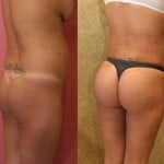 Buttock Lift/Augmentation Before & After Patient #6119