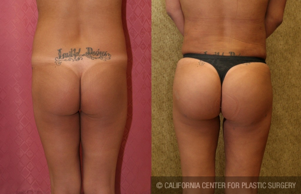 Buttock Lift/Augmentation Before & After Patient #6119