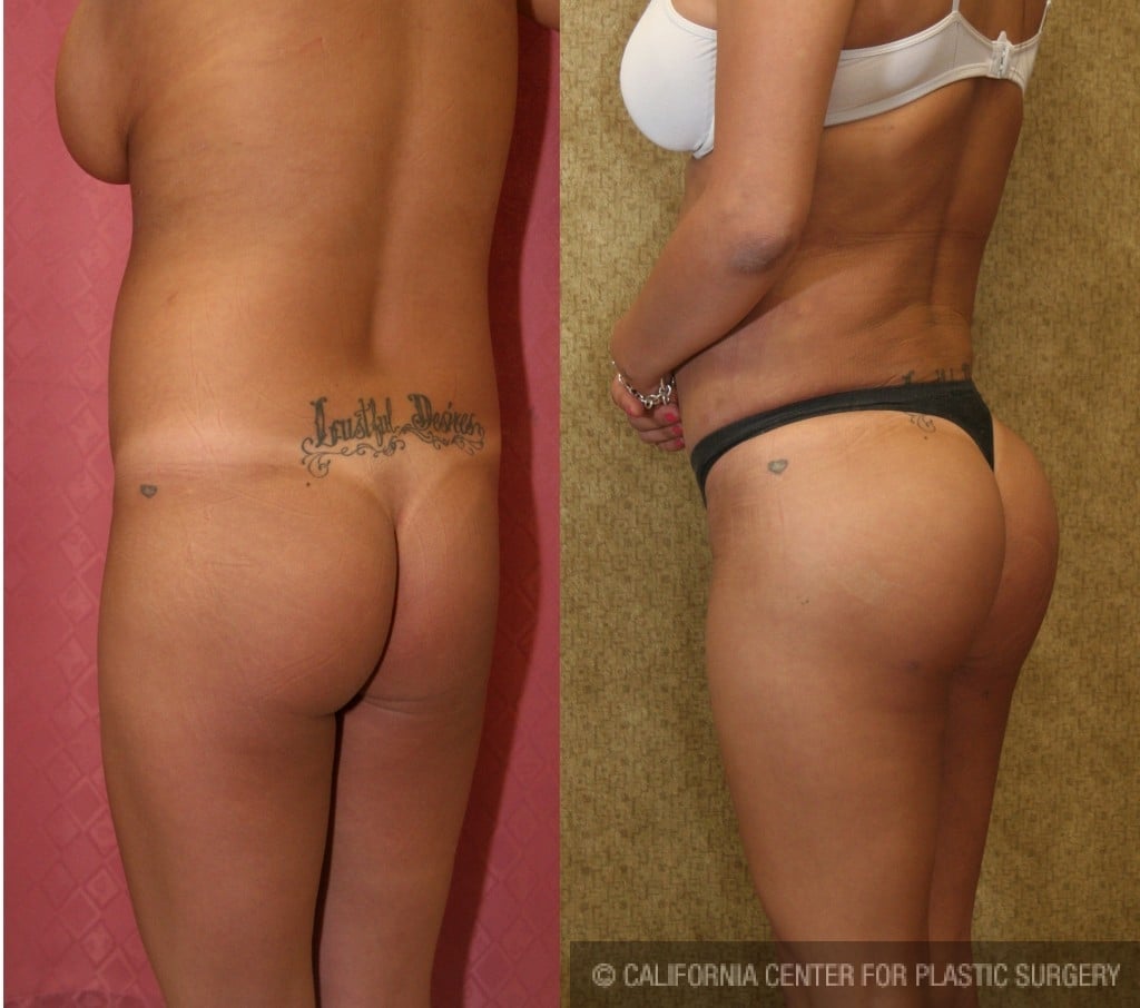 Buttock Lift/Augmentation Before & After Patient #6119