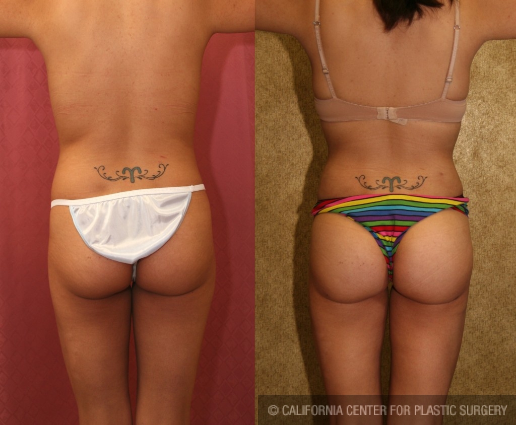 Buttock Lift/Augmentation Before & After Patient #6109