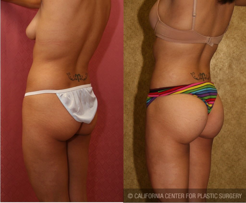 Buttock Lift/Augmentation Before & After Patient #6109