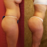 Buttock Lift/Augmentation Before & After Patient #6071