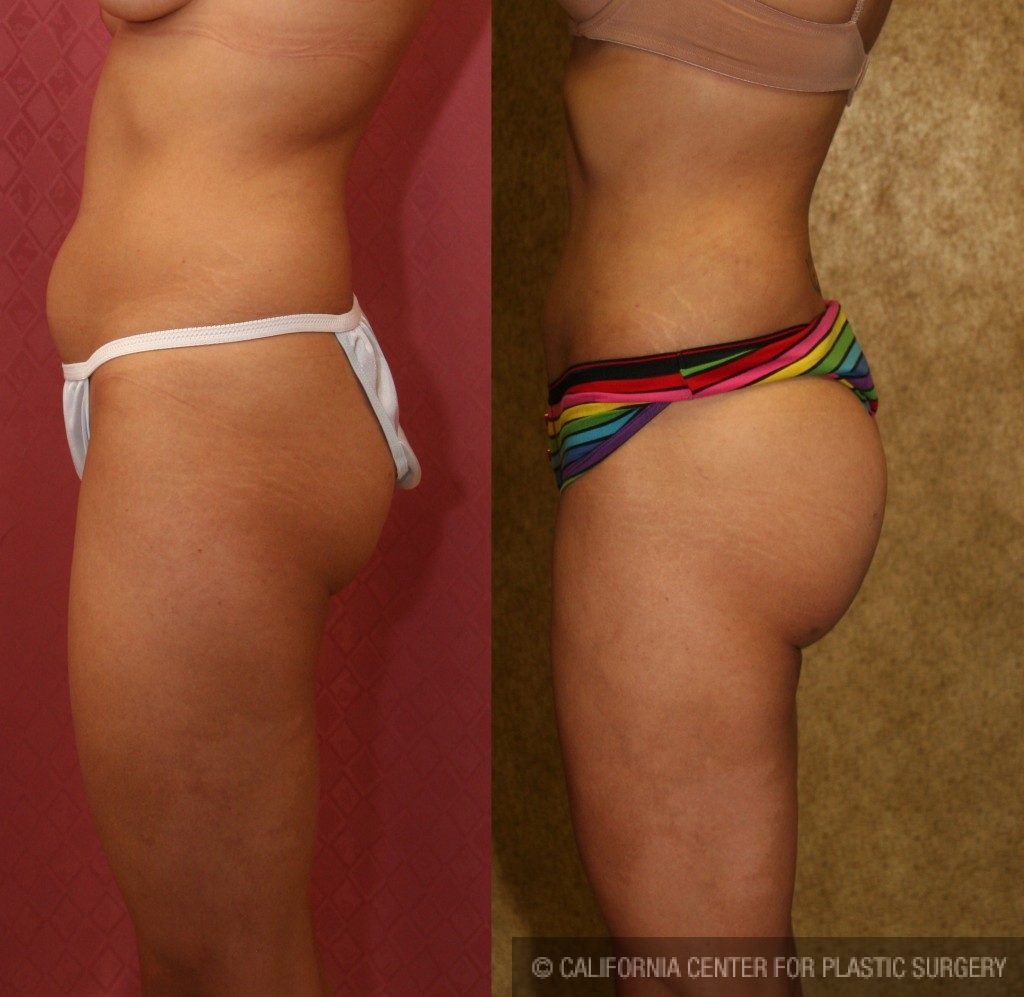 Buttock Lift/Augmentation Before & After Patient #6109