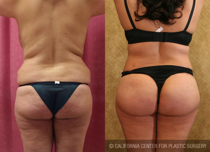 Buttock Lift/Augmentation Before & After Patient #6152