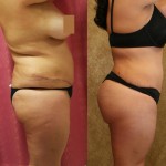 Buttock Lift/Augmentation Before & After Patient #6152