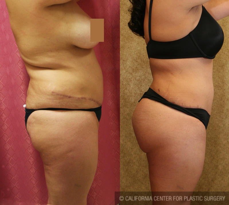 Buttock Lift/Augmentation Before & After Patient #6152